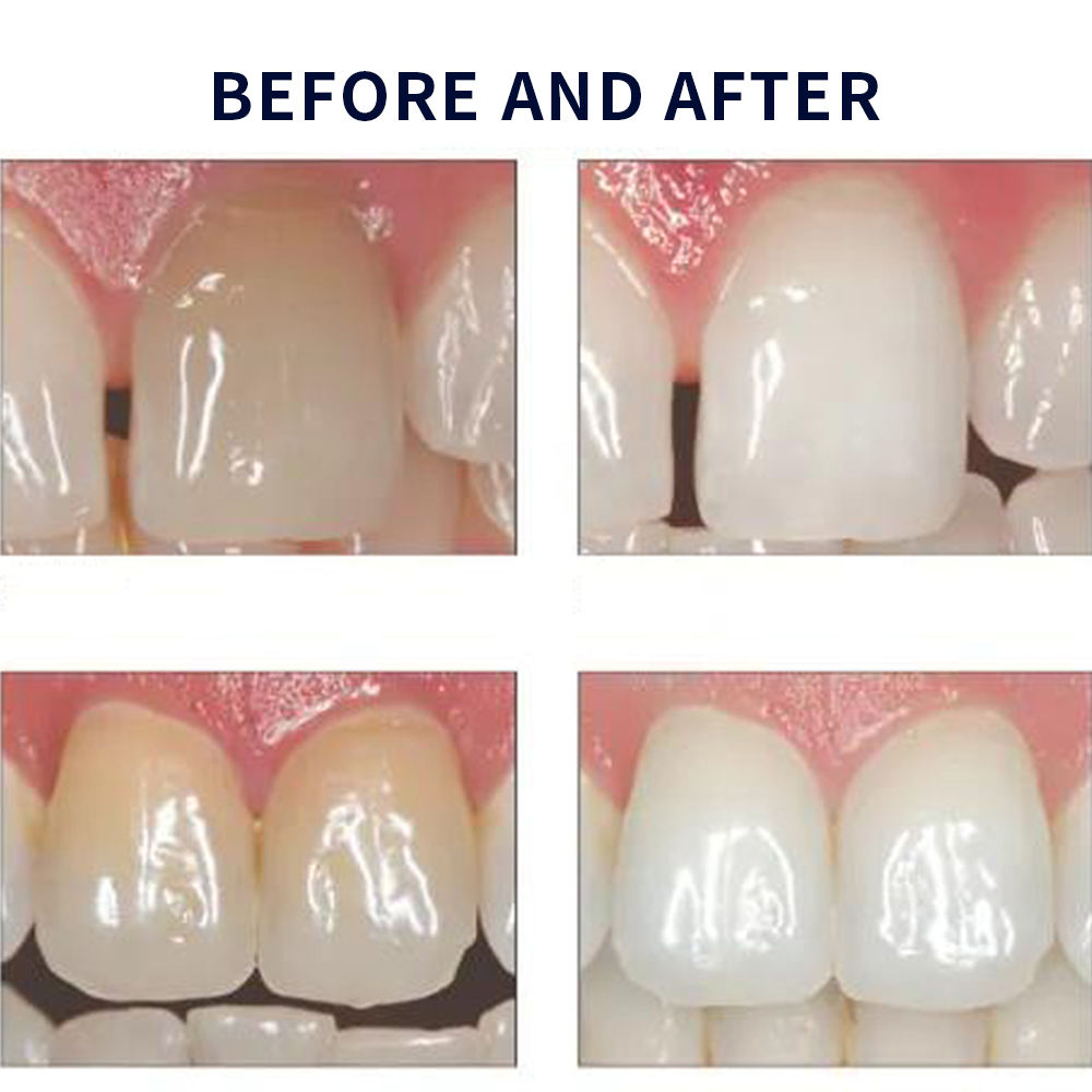 Opalescencia blanqueadora 20%  - Teeth Whitening In Office reseña y precio