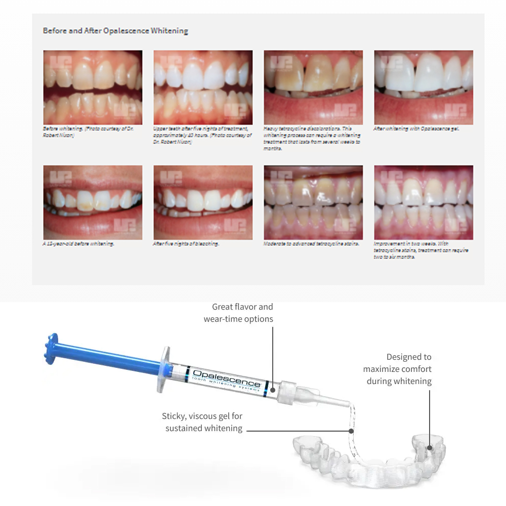 Opalescencia blanqueadora 20%  - Teeth Whitening In Office reseña y precio