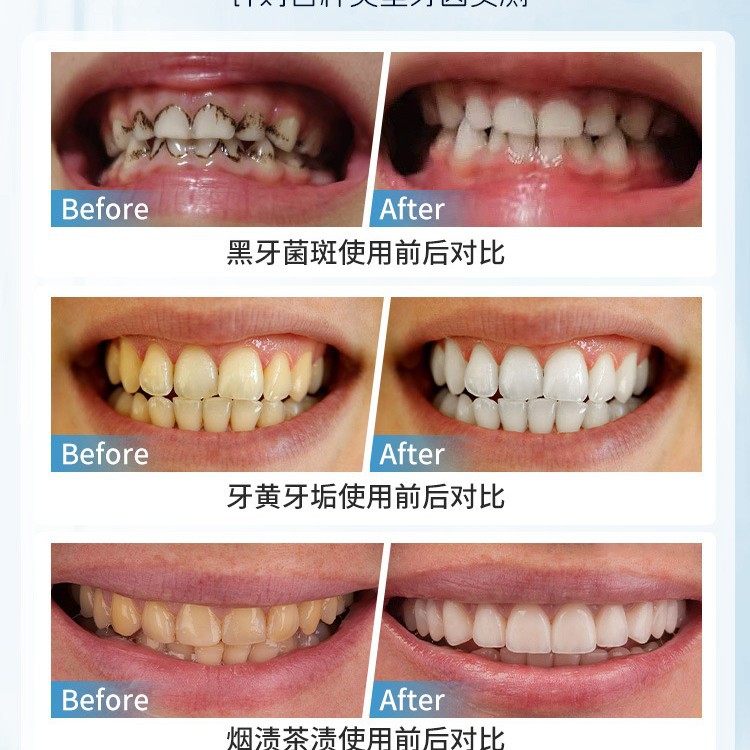 Cepillo de eliminación de manc - Teeth Whitening In Japan reseña y precio